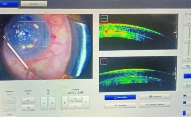 A Sutureless Corneal Transplantation (Intraop OCT Guided Descemet Stripping Automated Endothelial Keratoplasty) with Good Postoperative Outcome has been Successfully Conducted for the First Time at INHS Asvini.